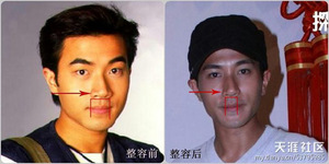 整容部位五，嘴唇 (縮唇，改變唇形)