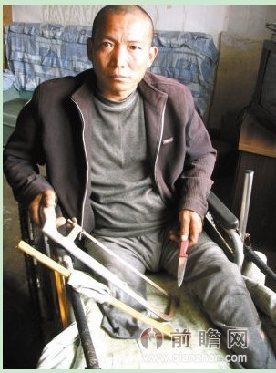 男子鋼鋸截肢右腿 患上怪病腿部潰爛自己自己動(dòng)手截肢