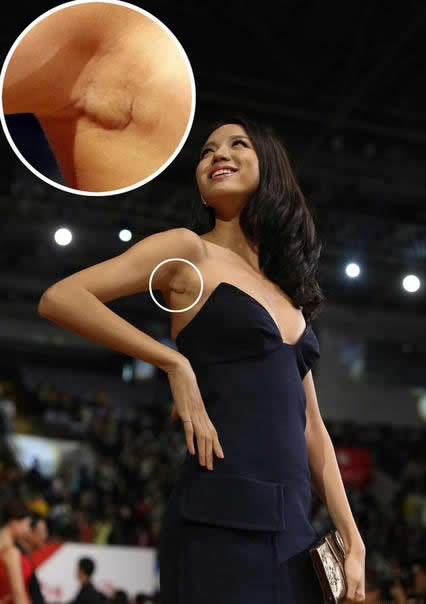 張梓琳腋下現疤痕