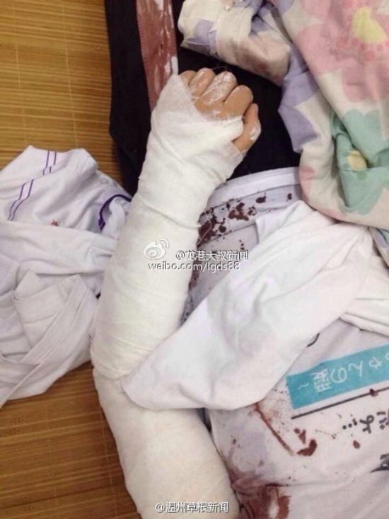蒼南龍港第九中學(xué)女生用剪刀捅傷同學(xué)