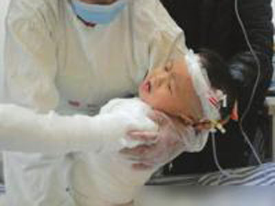 2歲男孩掉進湯鍋重度燙傷