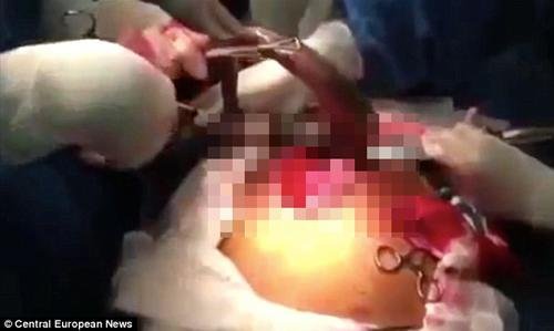 巴西男子腸道內取出活魚