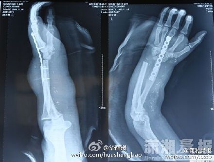 斷手寄養(yǎng)在小腿