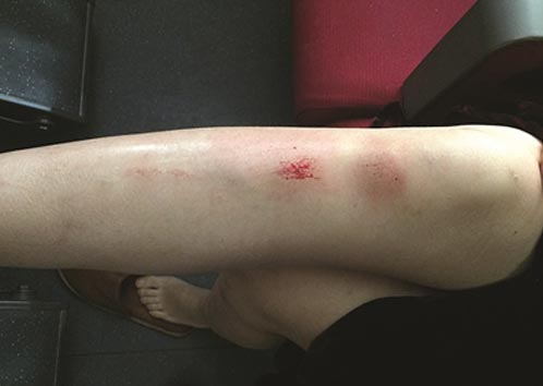 女子掉進站臺縫隙腿擦傷