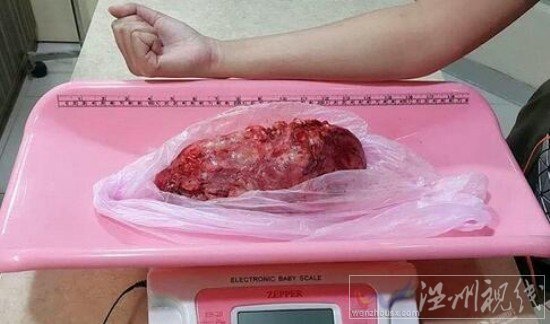 醫(yī)生為巨蟒切腫瘤