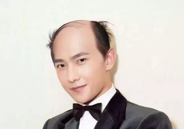 脫發更長壽上熱搜